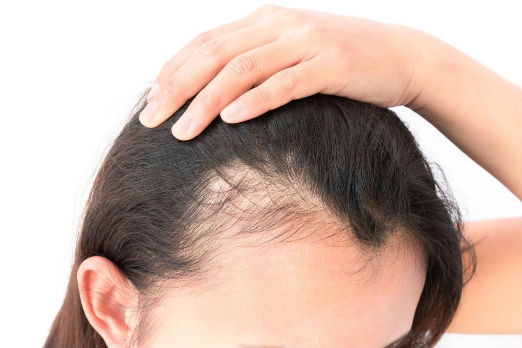 How to treat Baldness